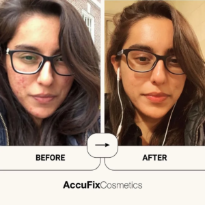 before after result of acufix s user 1.png
