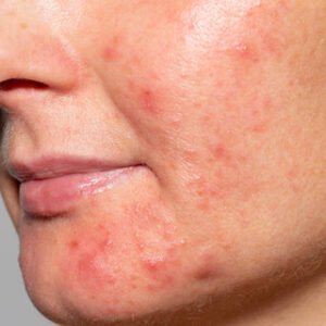 Blog cystic severe acne