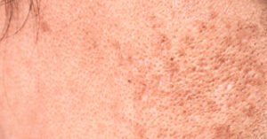 Blog seoon feature image pigmented skin copy